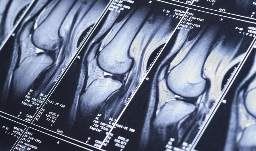 Knee MRI showing sport trauma, damage of cross-shaped ligaments