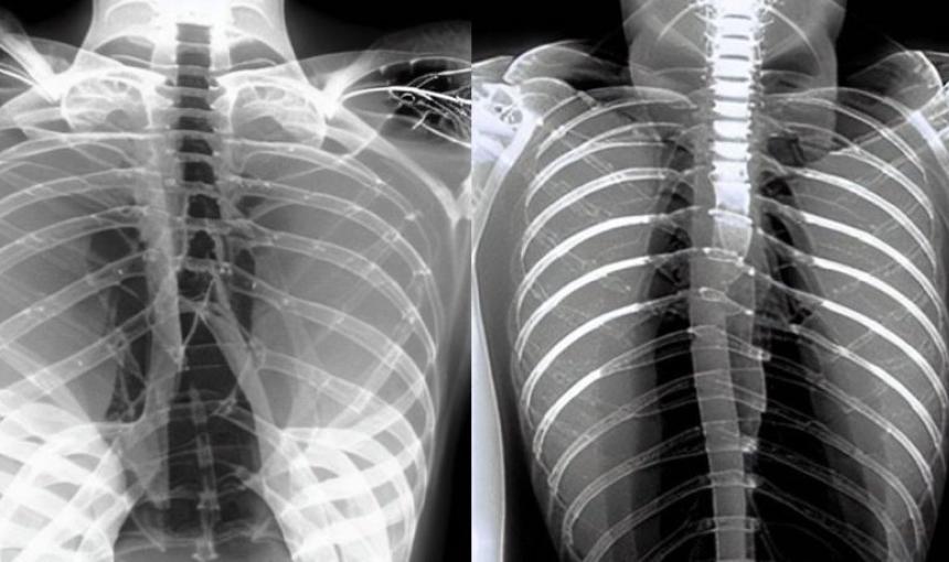 Chest x-rays created by stable diffusion