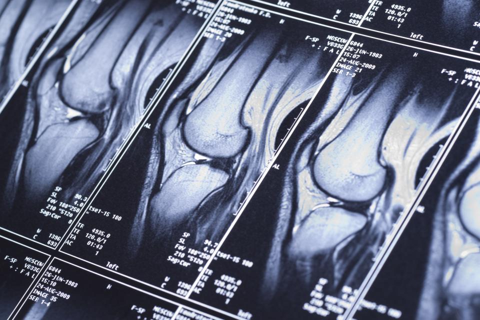Knee MRI showing sport trauma, damage of cross-shaped ligaments